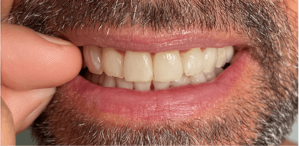 Patient 3 before treatment